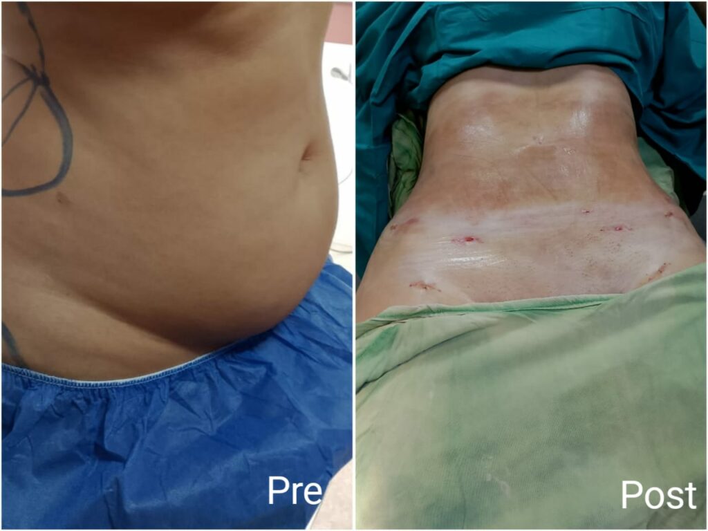 Tummy tuck before and after